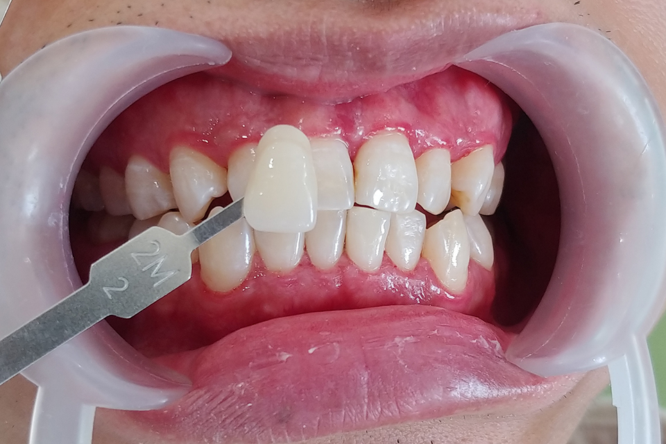 tẩy trắng răng 2